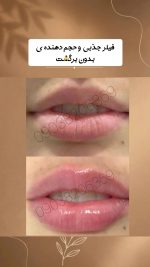 تونیک حجم دهنده لب دکس لاند lip plumper وزن ۲۰ میل - Image 2