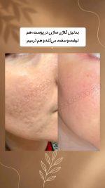 پک رفع کننده منافذ و اسکار دکس لاند شامل پودر،محلول،کرم و صابون، - Image 2