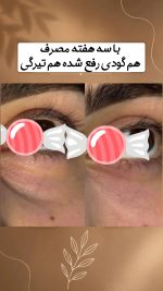 کرم فیلر رفع تیرگی و گودی زیر چشم دکس لاند حجم ۲۰ میل - Image 2