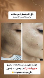 پک ضدلک و سفیدکننده پوست دکس لاند - Image 2