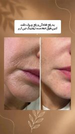 کرم ضد چروک خاویار ماتریکسل دکس لاند وزن 20 میل - Image 2